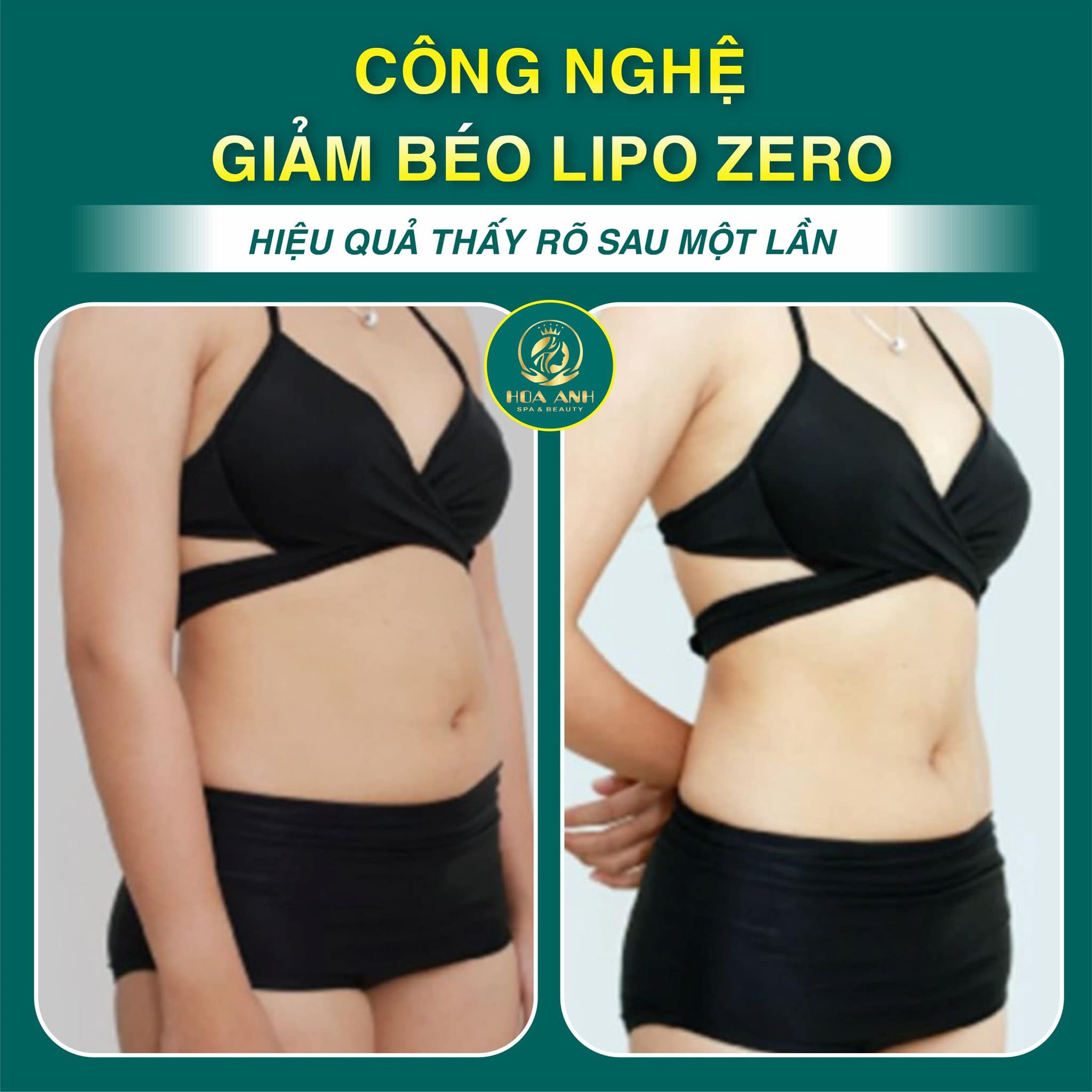 GIẢM BÉO AN TOÀN - GIẢM BÉO BỤNG BẰNG MÁY CÔNG NGHỆ LIPO ZERO KHÔNG CẦN ĂN KIÊNG