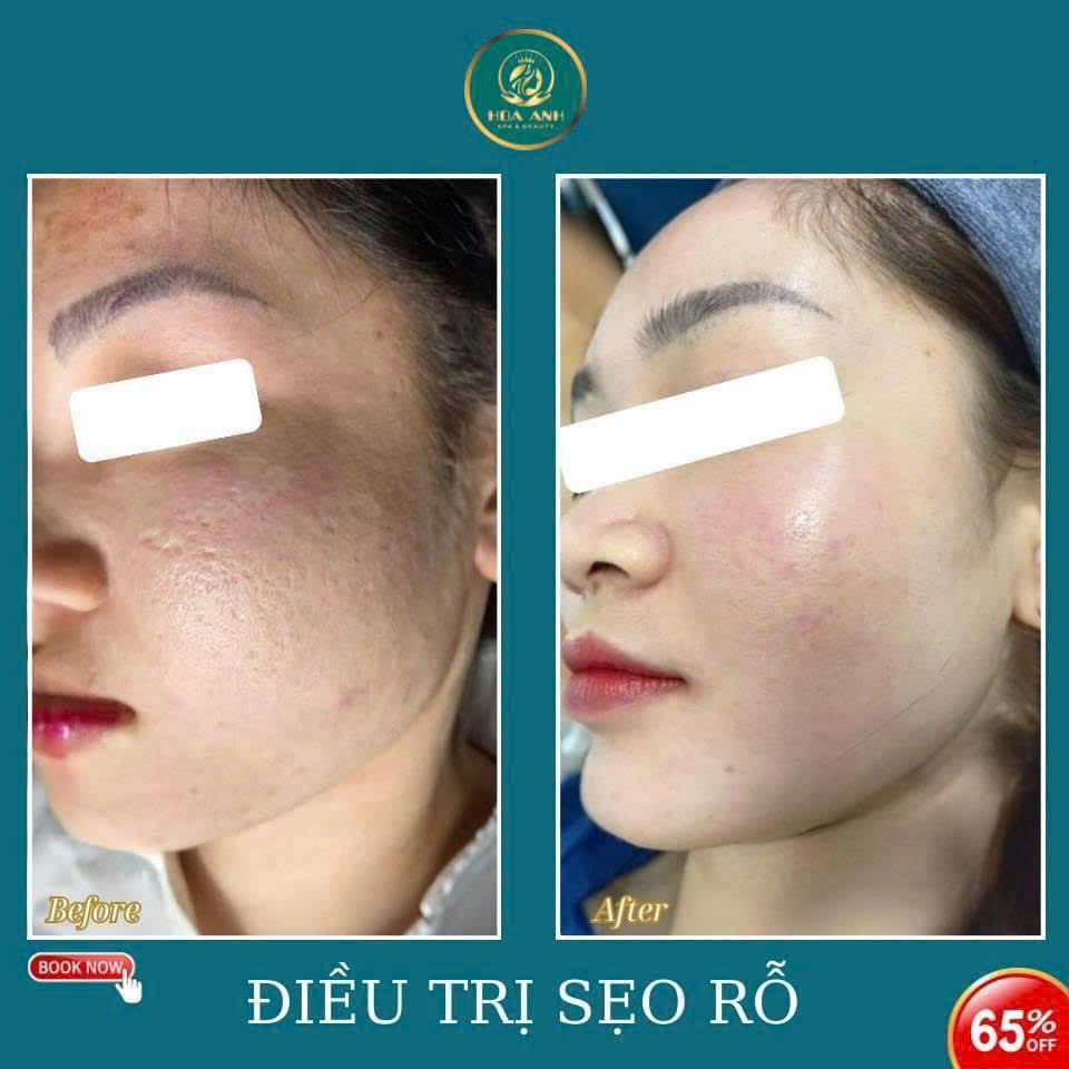 KHÓA HỌC ĐIỀU TRỊ SẸO RỖ