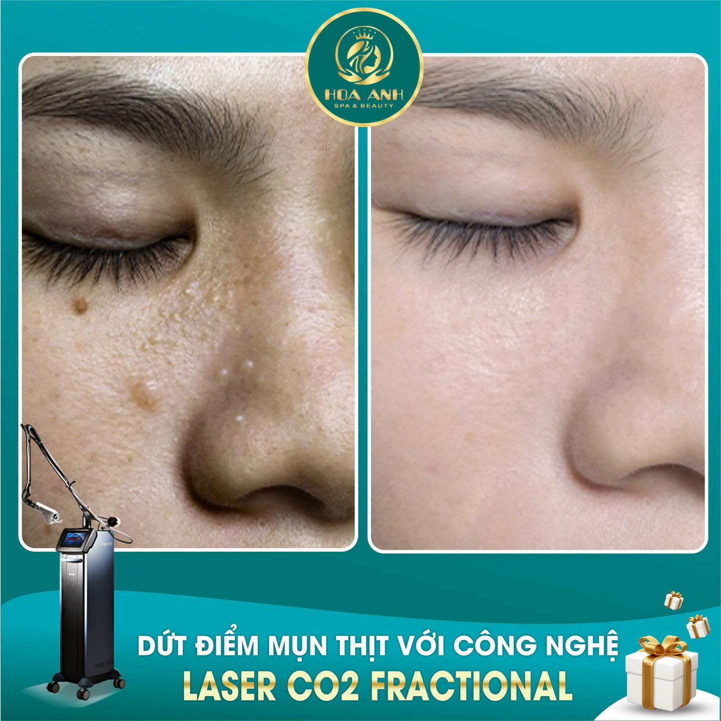 ĐỐT MỤN THỊT NHƯ THẾ NÀO ? CÁCH CHĂM SÓC DA SAU KHI ĐỐT MỤN THỊT