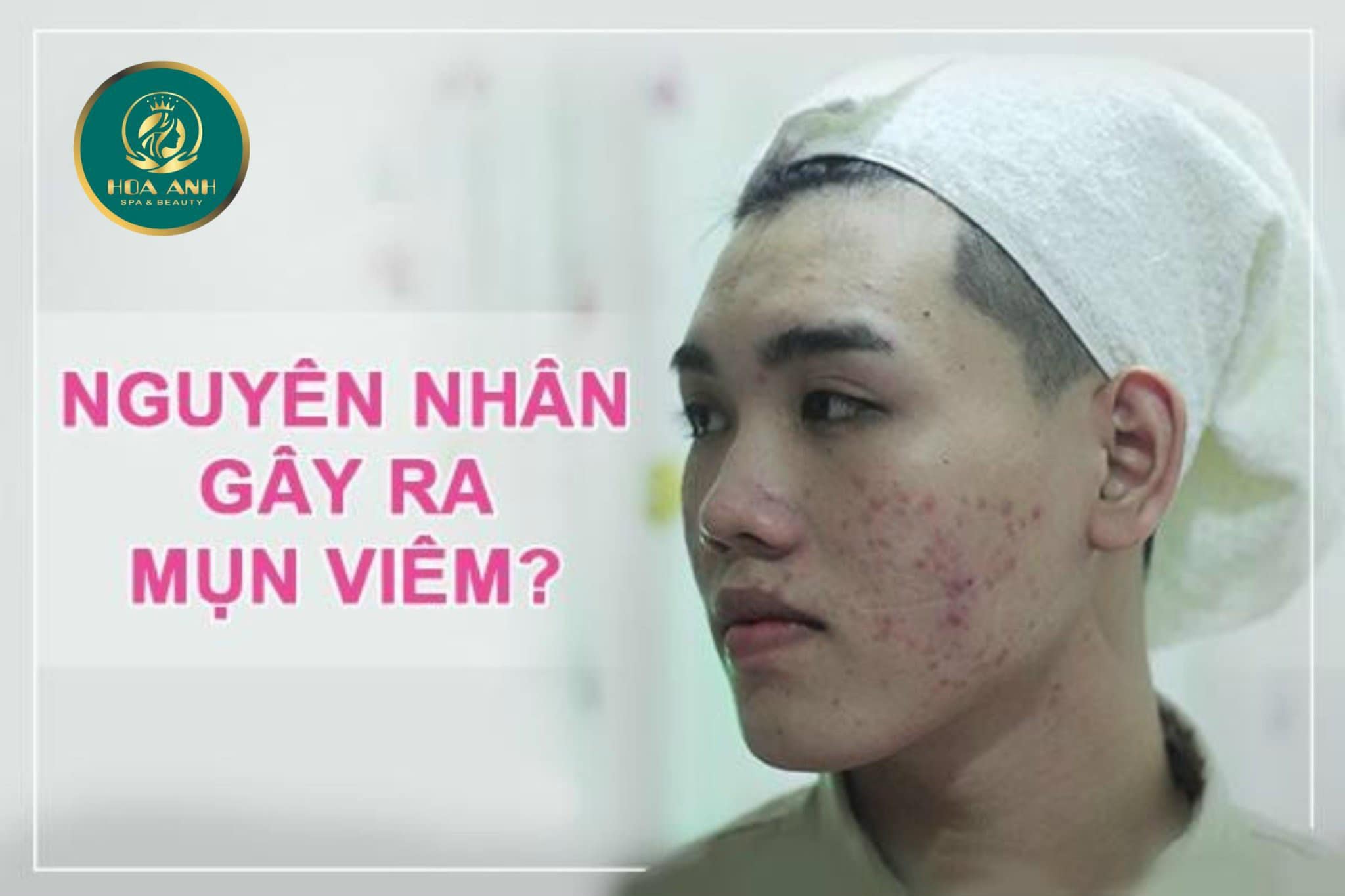 CÓ NÊN NẶN MỤN KHÔNG ? ĐIỀU TRỊ MỤN CHUẨN Y KHOA LÀ GÌ ?