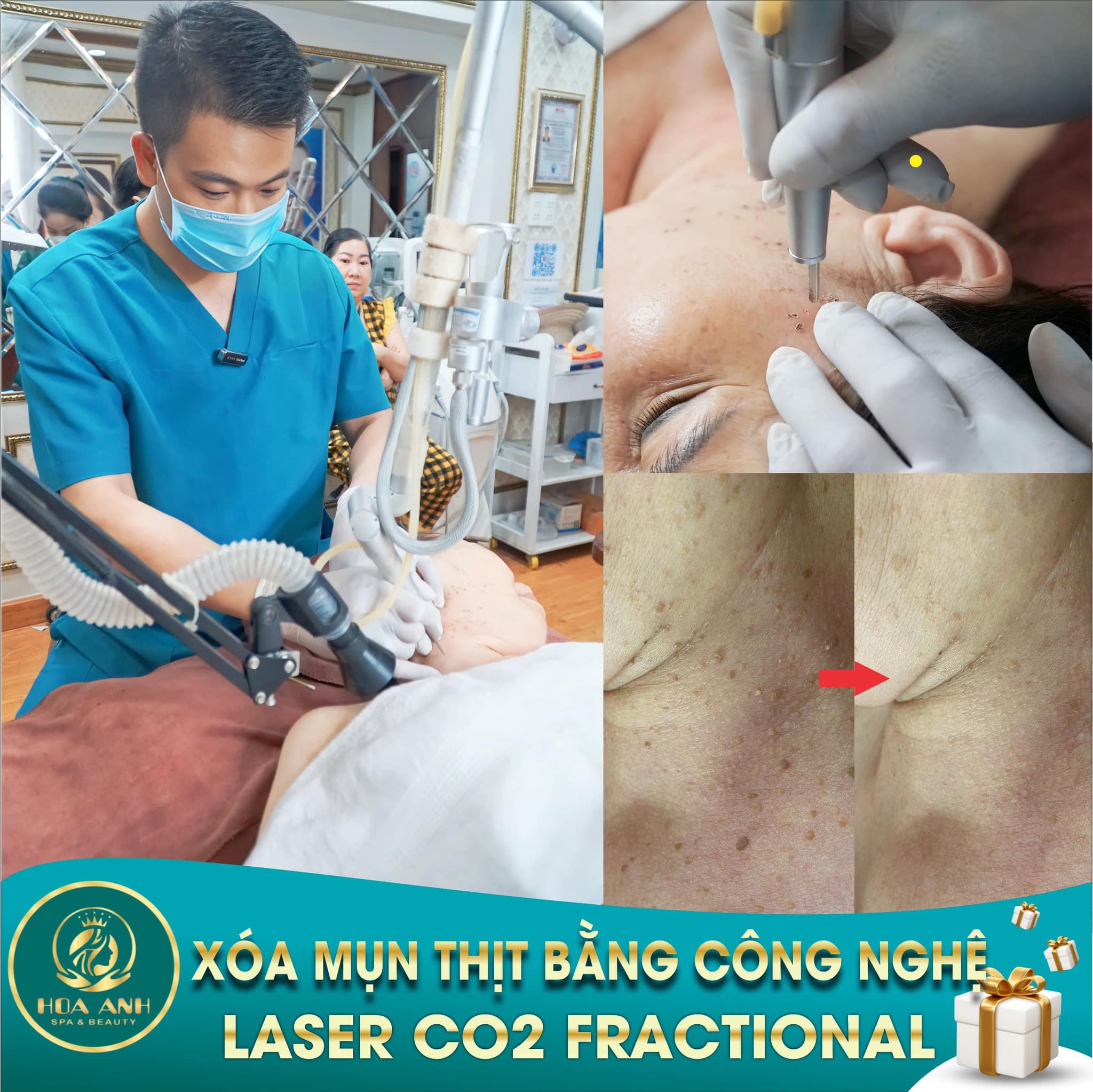 XÓA MỤN THỊT CÓ ĐỂ LẠI SẸO KHÔNG ? CÁCH CHĂM SÓC DA SAU KHI XÓA MỤN THỊT BẰNG LASER