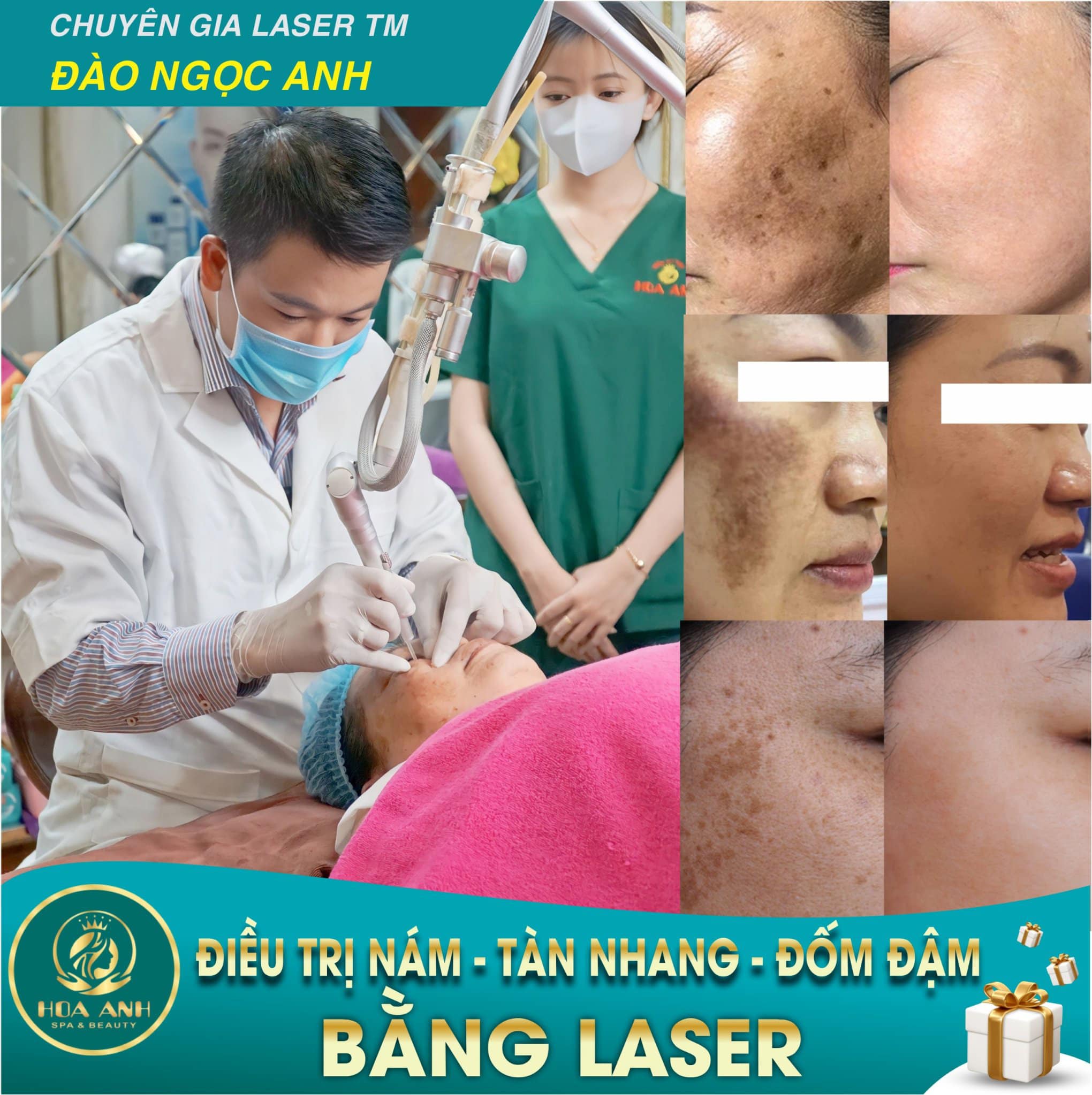 LÀM SAO ĐỂ THOÁT KHỎI TÀN NHANG ? ĐIỀU TRỊ TÀN NHANG BẰNG LASER