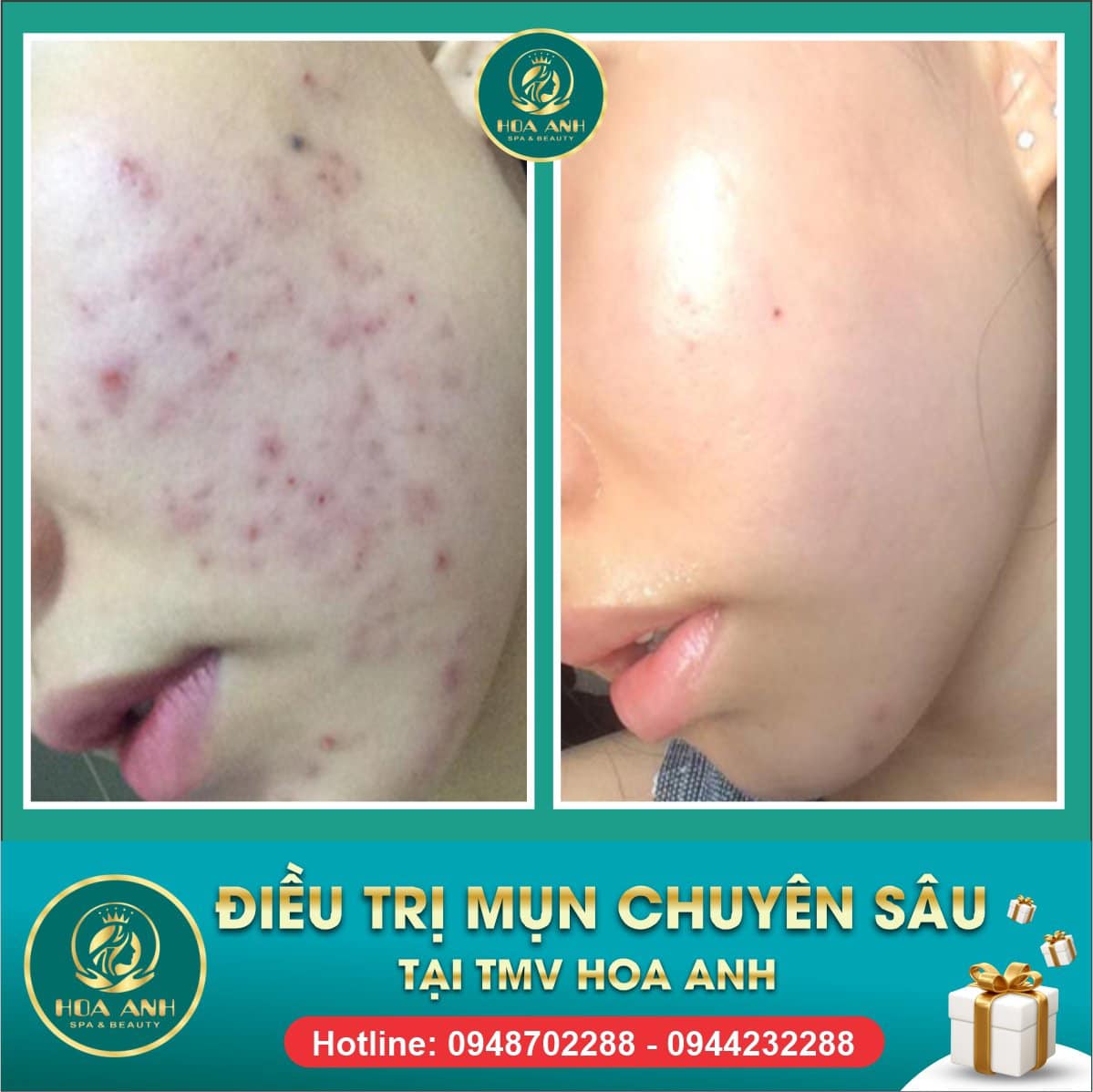 CÓ NÊN NẶN MỤN Ở NHÀ KHÔNG ? CÁCH CHĂM SÓC DA DÀNH CHO DA MỤN