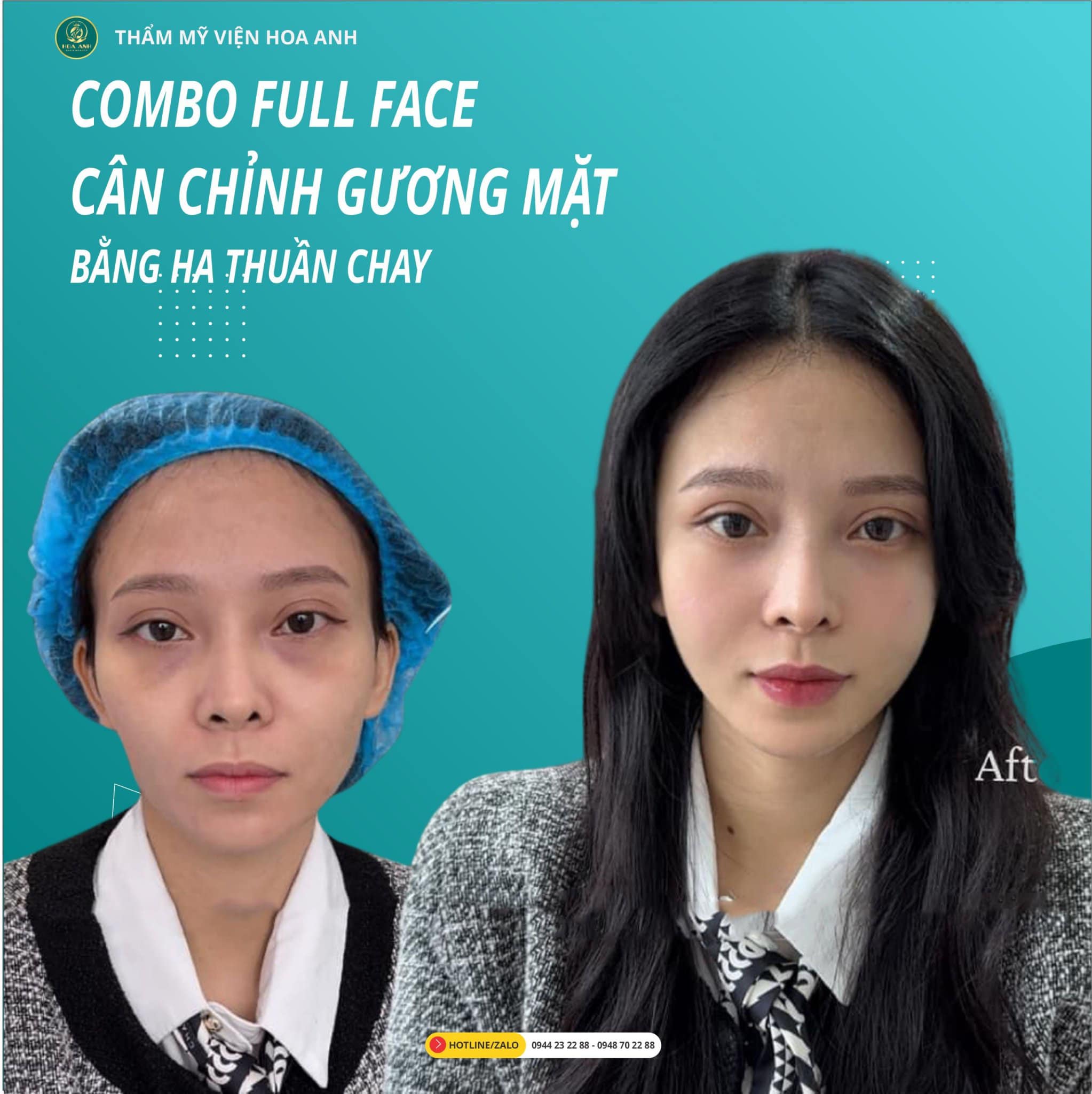 TIÊM FILLER MÁ BABY LÀ GÌ ? TIÊM FILLER MÁ BABY CÓ ẢNH HƯỞNG GÌ KHÔNG ?