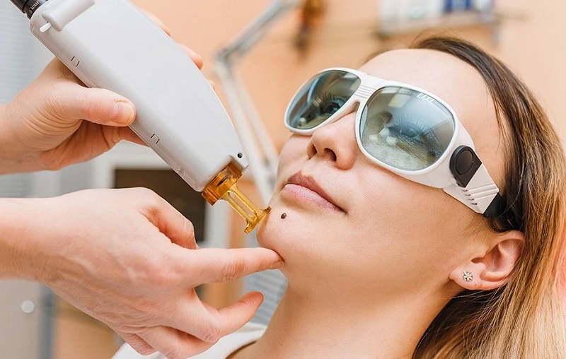 XÓA NỐT RUỒI KHÔNG AN TOÀN HIỆU QUẢ KHÔNG ĐỂ LẠI SẸO