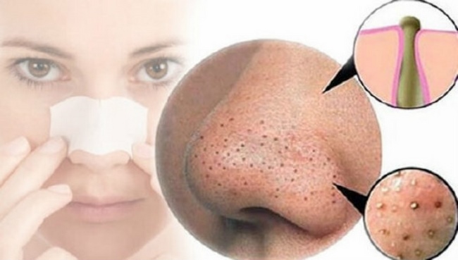 PHÂN BIỆT MỤN ĐẦU ĐEN VÀ SỢI BÃ NHỜN, CÁC ĐIỀU TRỊ HIỆU QUẢ