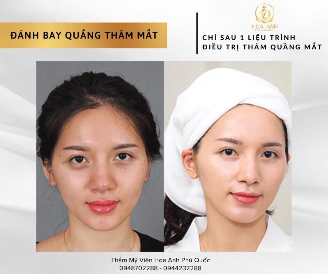 CẤY MESO TRỊ QUẦNG THÂM MẮT LÀ GÌ ? MESO TRỊ THÂM MẮT CÓ HIỆU QUẢ KHÔNG