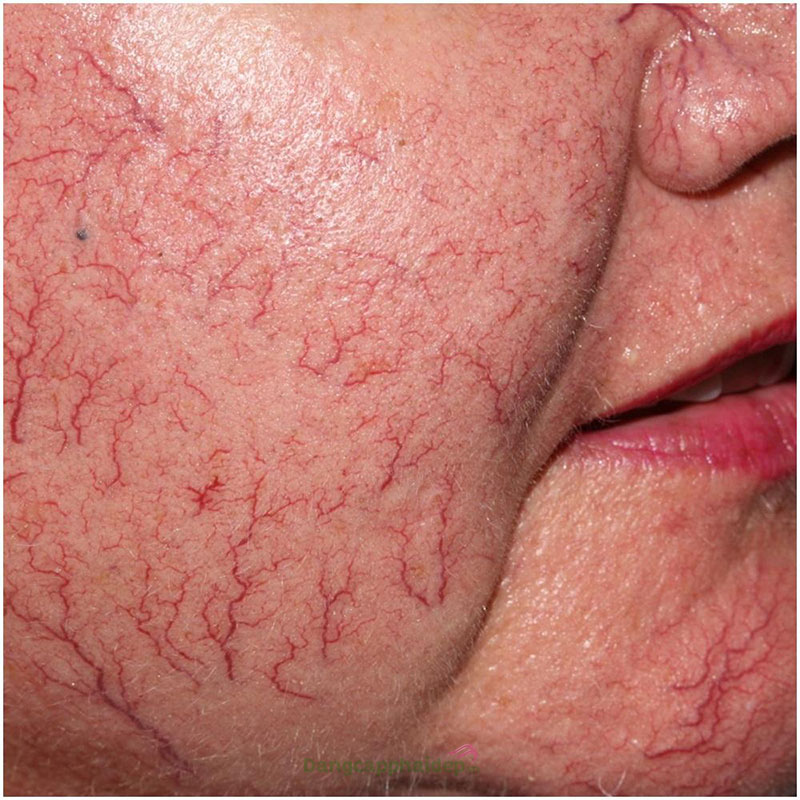 KHÓA HỌC ĐIỀU TRỊ ĐỎ DA – MAO MẠCH ĐỎ CHUYÊN SÂU TẠI THẨM MỸ VIỆN HOA ANH