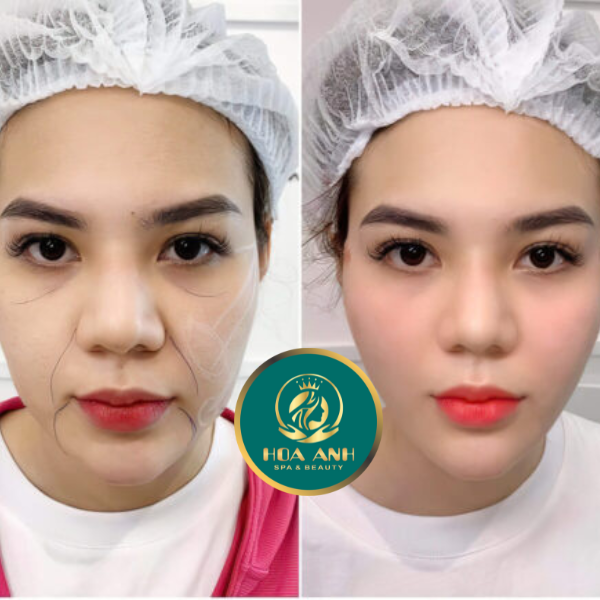 Khóa Học Tiêm Filler Chuyên Nghiệp – Nâng Tầm Tay Nghề Làm Đẹp