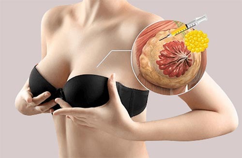 TIÊM FILLER NÂNG NGỰC CÓ AN TOÀN KHÔNG ? TIÊM FILLER NGỰC GIỮ ĐƯỢC BAO LÂU