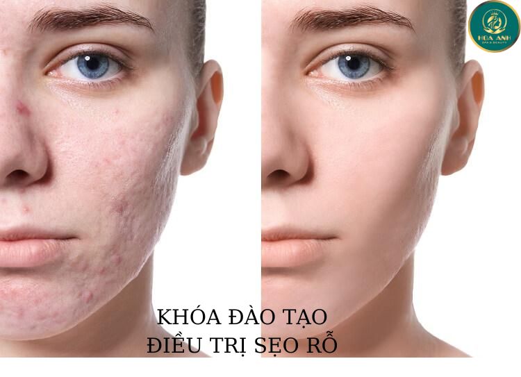 KHÓA ĐÀO TẠO ĐIỀU TRỊ SẸO RỖ