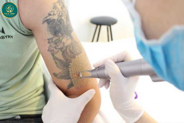 Khóa Học Xóa Xăm Bằng Công Nghệ Laser – Cơ Hội Nghề Nghiệp Đầy Tiềm Năng