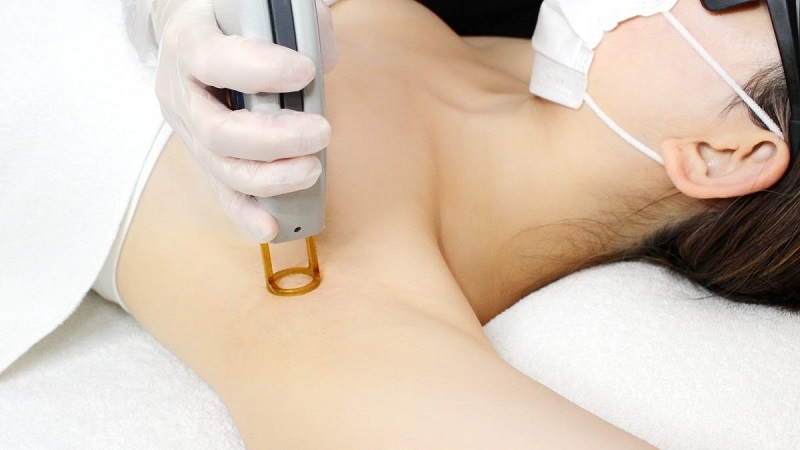 DÙNG LASER TRỊ THÂM HIỆU QUẢ TRÊN VÙNG DA NÀO ? NHỮNG LƯU Ý KHI TRỊ THÂM BẰNG LASER