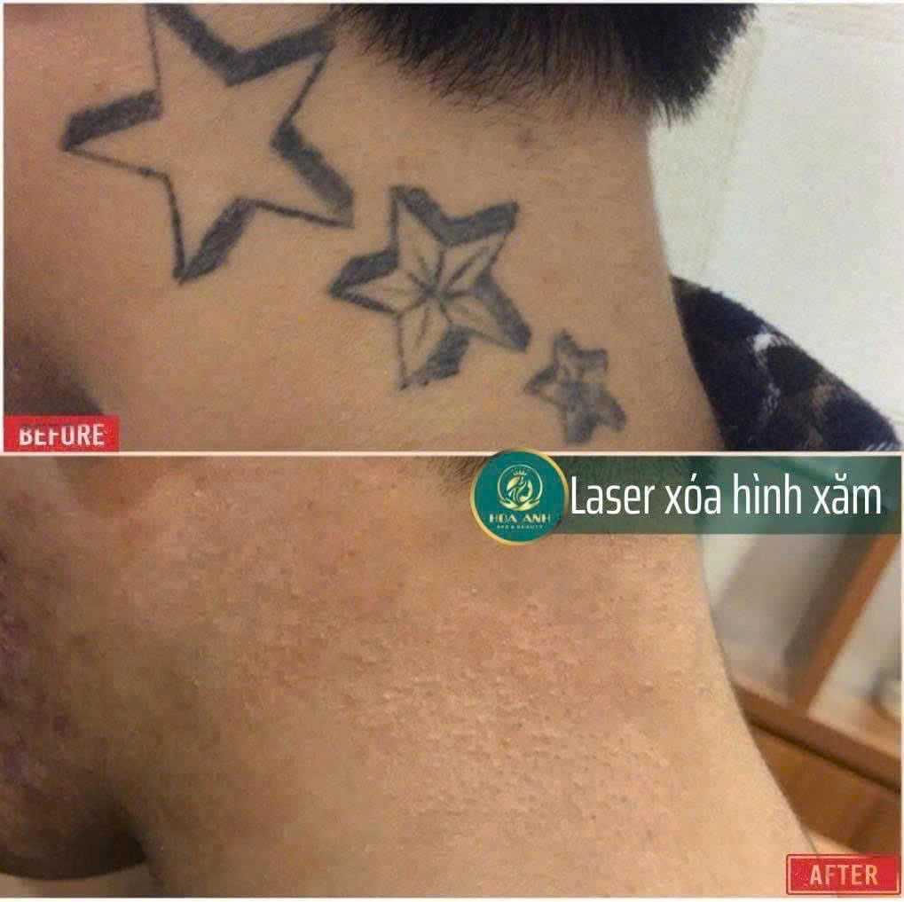 KHÓA HỌC XÓA HÌNH XĂM – CƠ HỘI LÀM CHỦ CÔNG NGHỆ LASER HIỆN ĐẠI