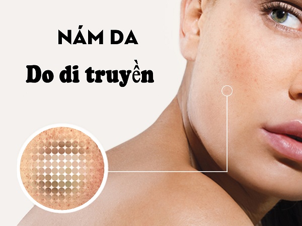 CÁC LOẠI NÁM THƯỜNG GẶP Ở ĐỘ TUỔI TRUNG NIÊN - TRỊ NÁM TẬN GỐC BẰNG LASER LÀ GÌ