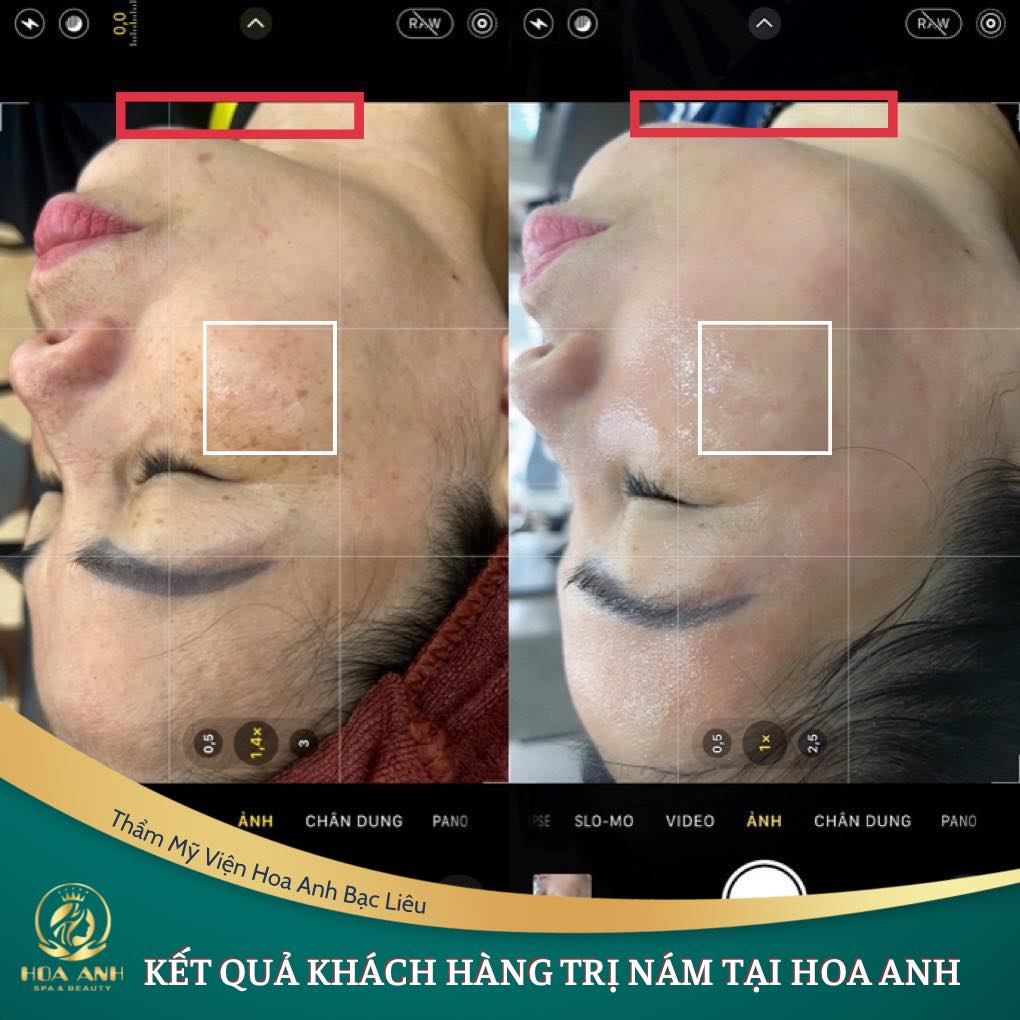 CÁC NGUYÊN NHÂN DẪN ĐẾN NÁM TÀN NHANG TRÊN DA CÁC CHỊ EM THƯỜNG MẮT PHẢI
