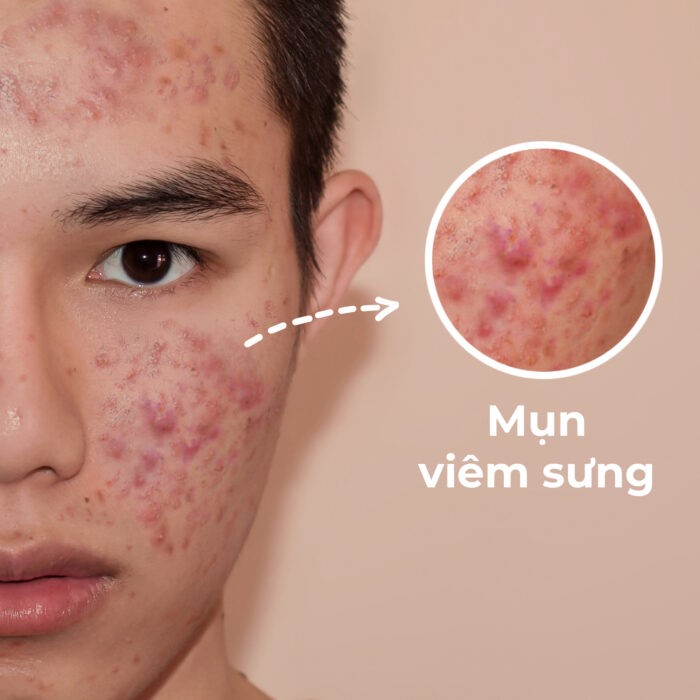 CÓ NÊN ĐI SPA NẶN MỤN KHÔNG ? CÁCH CHĂM SÓC DA TẠI NHÀ SAU KHI NẶN MỤN TẠI SPA