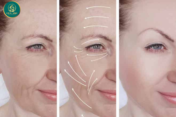 Nâng Cơ HIFU – Kỹ Thuật Hot Trong Ngành Thẩm Mỹ Hiện Đại