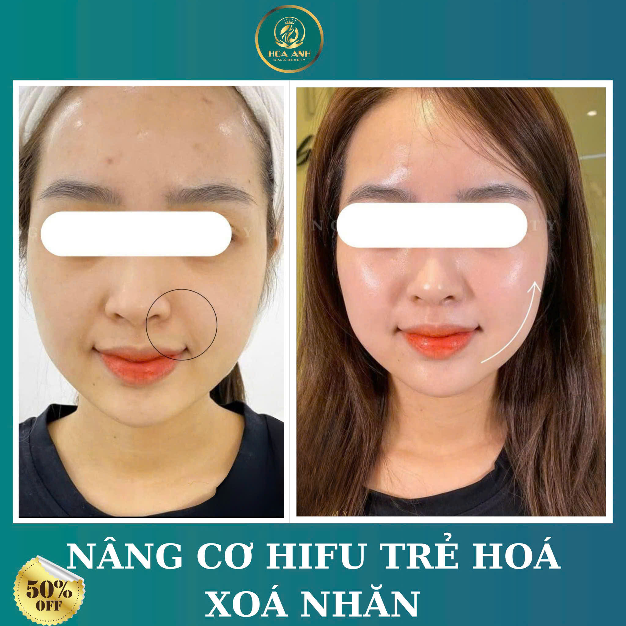 Khóa Học Trẻ Hóa Bằng Công Nghệ HIFU – Bí Quyết Làm Đẹp Thời Thượng