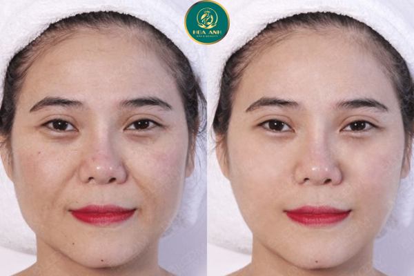 KHÓA HỌC NÂNG CƠ BẰNG CÔNG NGHỆ HIFU – ĐỘT PHÁ TRONG TRẺ HÓA DA