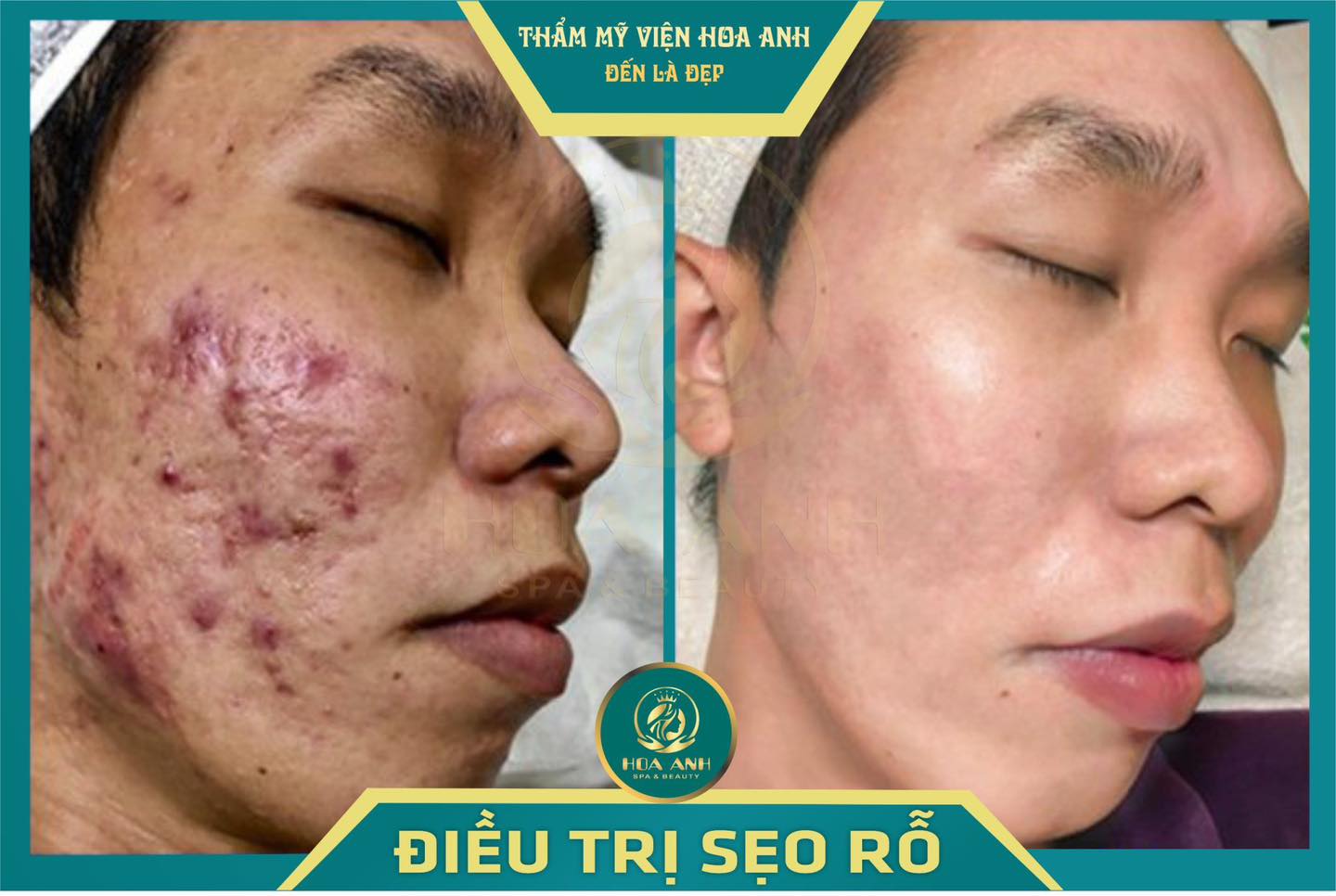 ĐIỀU TRỊ SẸO RỖ BẰNG LASER CO2 FRACTIONAL CÓ THỰC SỰ HIỆU QUẢ KHÔNG ?