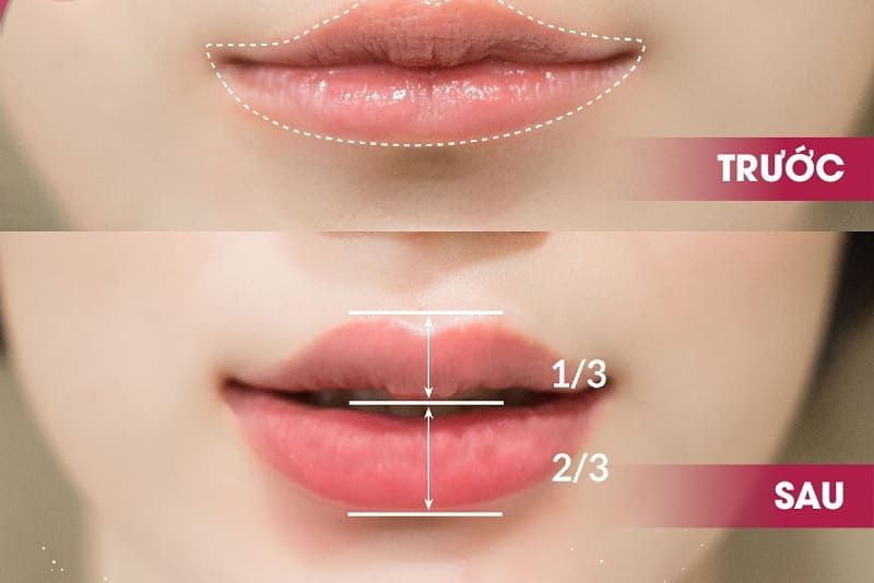 TIÊM FILLER MÔI CÓ ẢNH HƯỞNG GÌ KHÔNG? CÓ HIỆU QUẢ ĐƯỢC BAO LÂU?