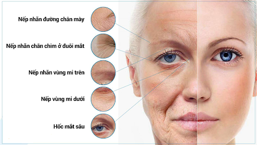 TIÊM BOTOX XÓA NẾP NHĂN - CHĂM SÓC DA KHI TIÊM BOTOX XÓA NHĂN