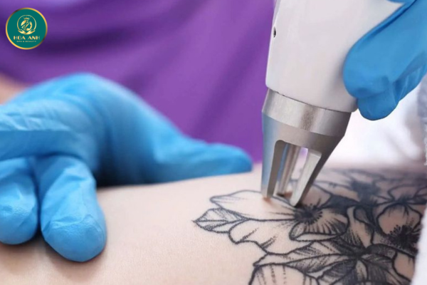 Khóa Học Xóa Hình Xăm Bằng Công Nghệ Laser – Cơ Hội Nghề Nghiệp Hấp Dẫn Trong Ngành Thẩm Mỹ