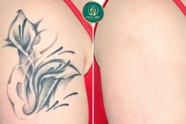 Khóa Học Xóa Xăm Bằng Laser – Xu Hướng Được Nhiều Spa, Thẩm Mỹ Viện Lựa Chọn