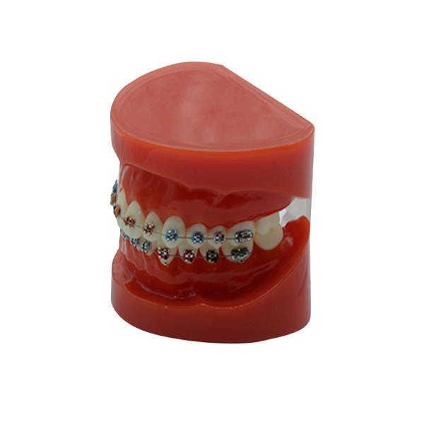 Mô hình chỉnh nha mắc cài kim loại cố định