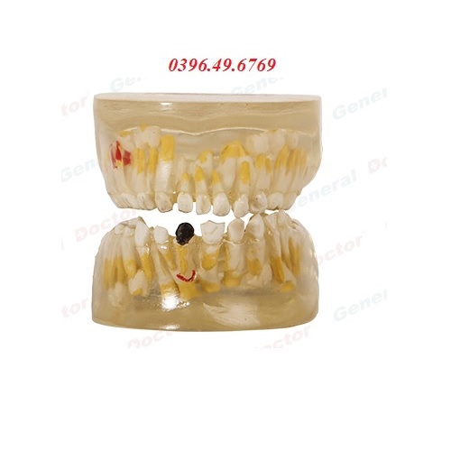 Mô hình bệnh lý răng sữa trong suốt model GD/B10013