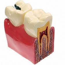 Mô hình răng sâu phóng đại 6 lần