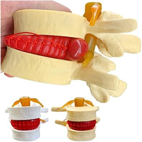 Mô hình bệnh lý thoát vị đĩa đệm