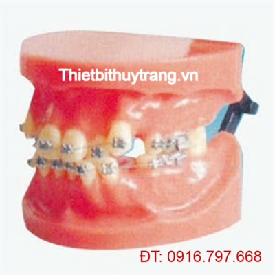 MÔ HÌNH CHỈNH NHA CỐ ĐỊNH (TRẬT KHỚP) GD/B10038