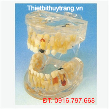 MÔ HÌNH GIẢI PHẪU BỆNH LÝ RĂNG SỮA TRONG SUỐT GD/B10013