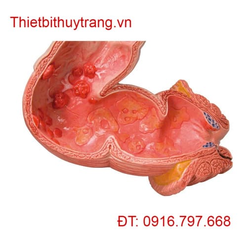 Mô Hình Ruột Già 3B Scientific 1008496