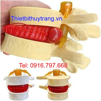 Mô Hình Thoát Vị Đĩa Đệm TVDD