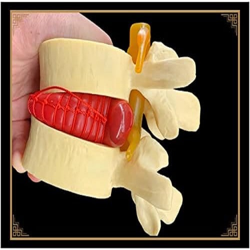 Mô Hình Thoát Vị Đĩa Đệm /Mô Hình Giải Phẫu Thoát Vị Đĩa Đệm Thắt Lưng /Mô Hình Cột Sống Con Người