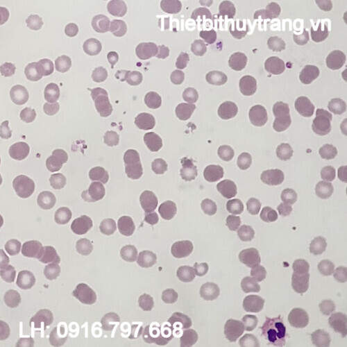 TIÊU BẢN THALASSEMIA