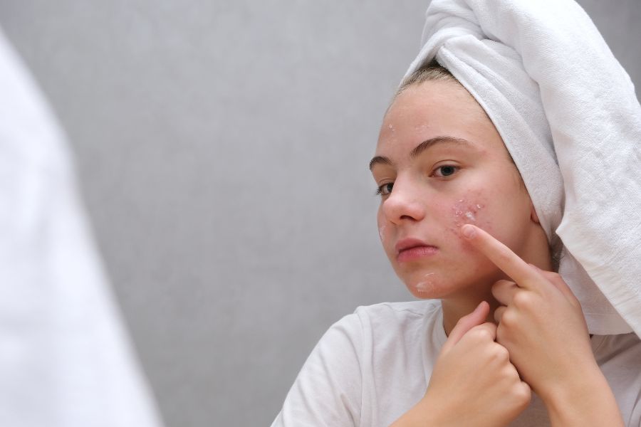 Những lưu ý khi chọn mua kem trị mụn Nhật Bản