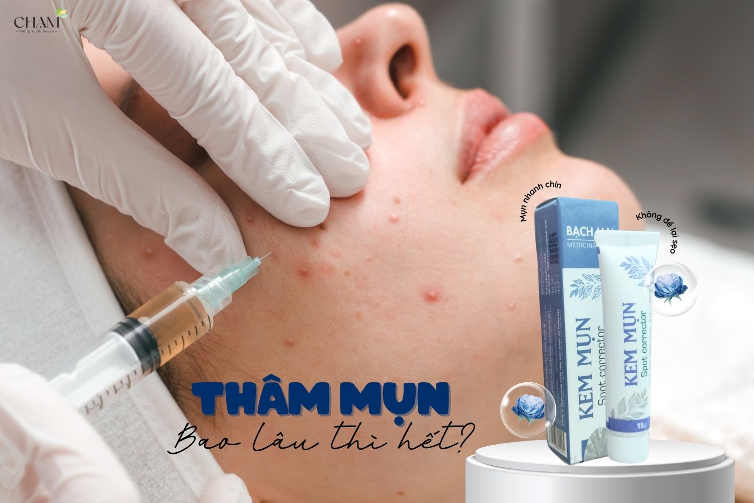 Thâm mụn có tự hết không? Thâm mụn bao lâu thì hết?