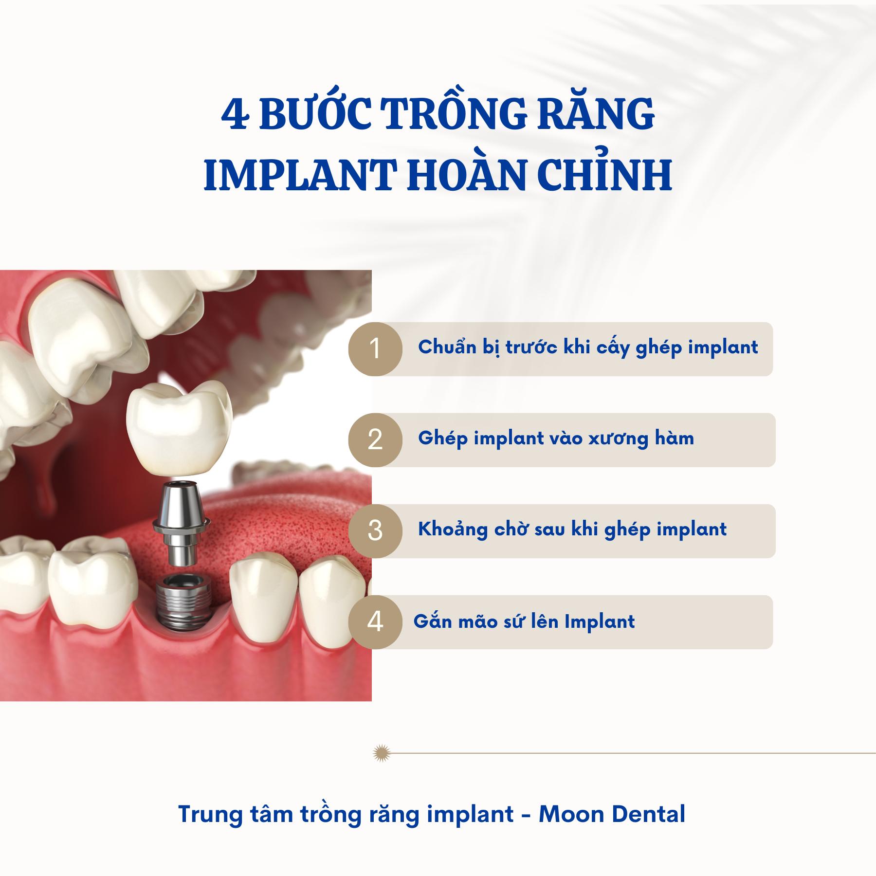  4 BƯỚC TRỒNG RĂNG IMPLANT HOÀN CHỈNH