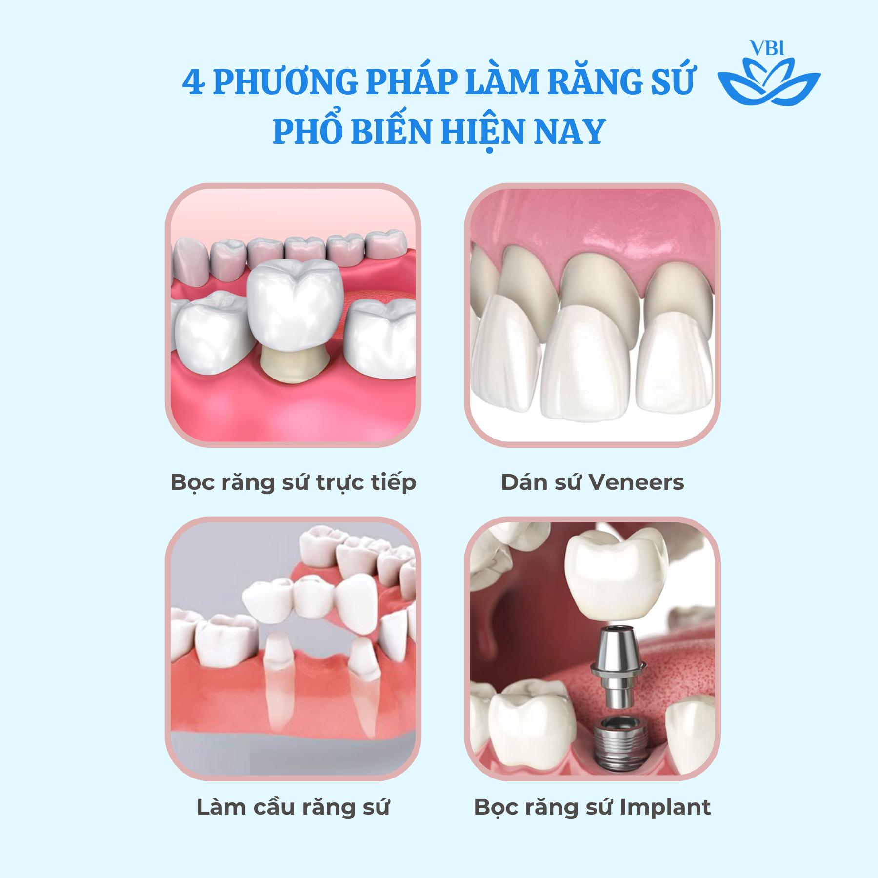 4 PHƯƠNG PHÁP LÀM RĂNG SỨ PHỔ BIẾN HIỆN NAY