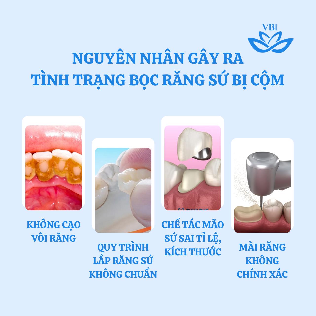  NGUYÊN NHÂN GÂY RA TÌNH TRẠNG BỌC RĂNG SỨ BỊ CỘM