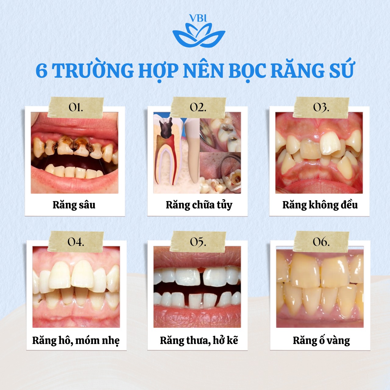 6 TRƯỜNG HỢP NÊN BỌC RĂNG SỨ BẠN CẦN BIẾT