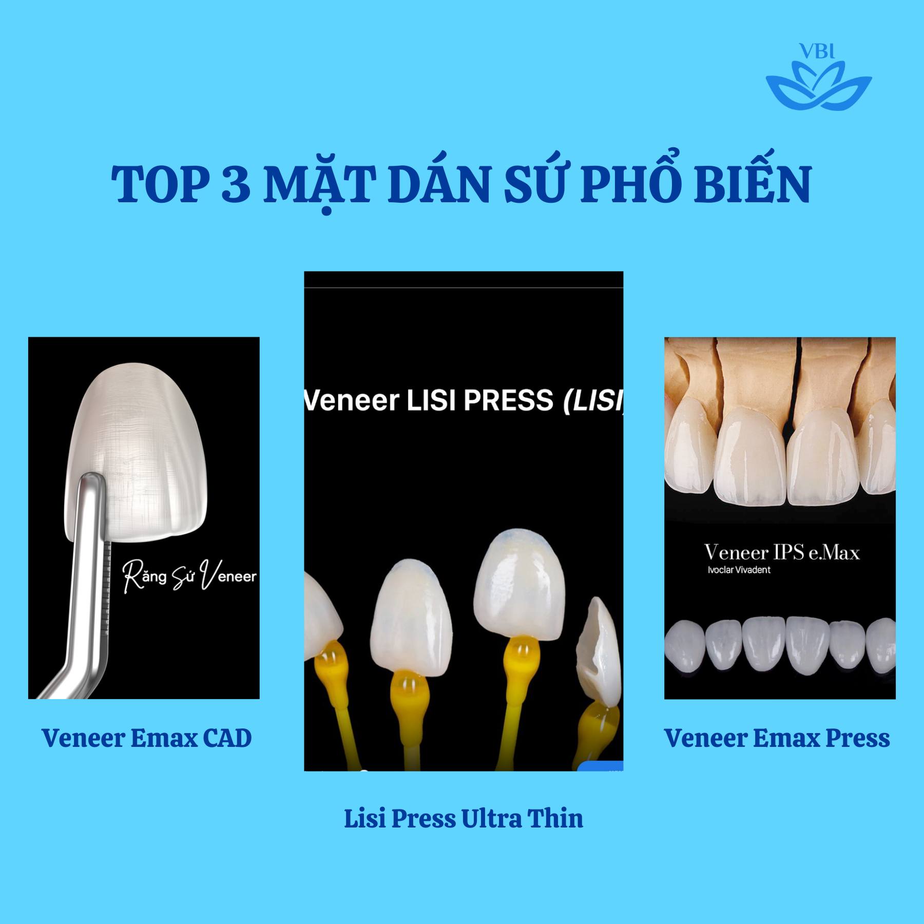 TOP 3 MẶT DÁN SỨ PHỔ BIẾN HIỆN NAY