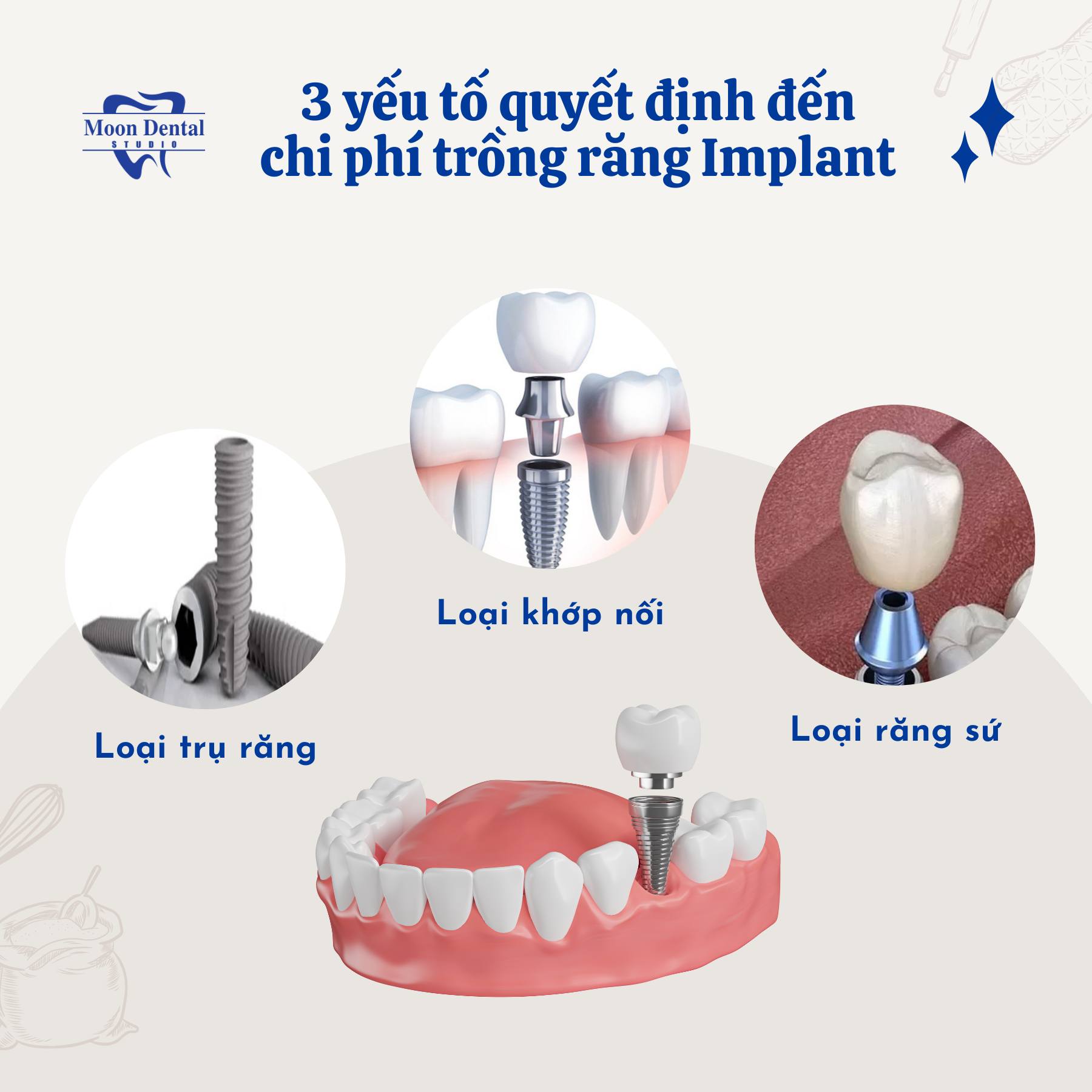 3 YẾU TỐ QUYẾT ĐỊNH ĐẾN CHI PHÍ TRỒNG RĂNG IMPLANT