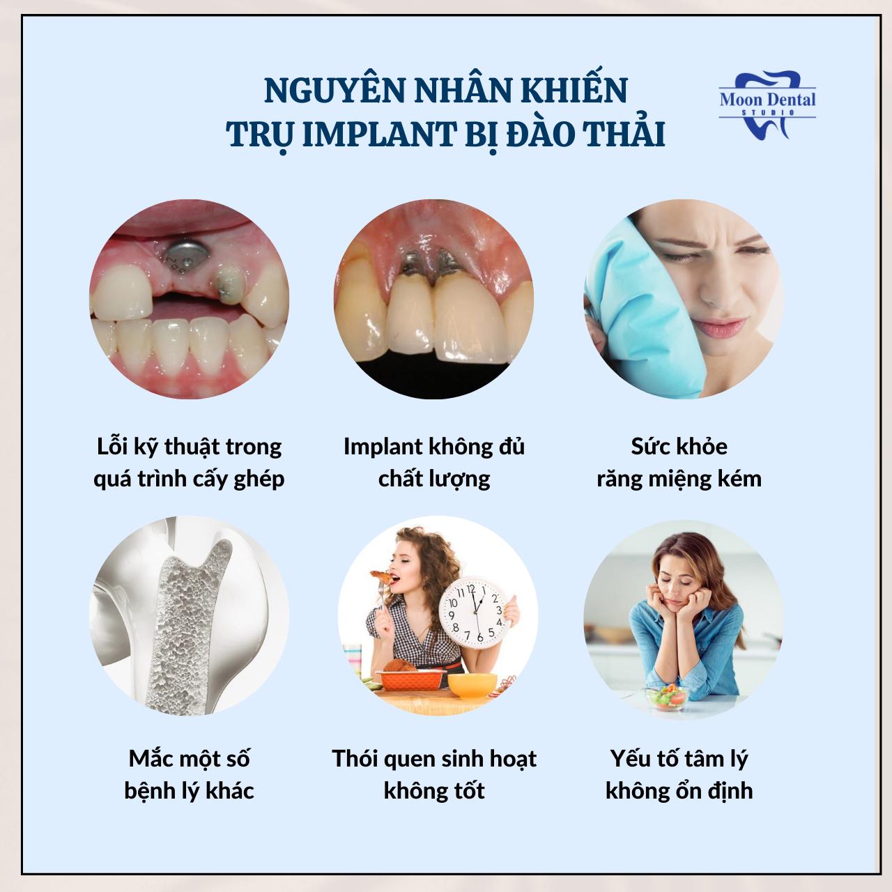 NHỮNG NGUYÊN NHÂN KHIẾN TRỤ IMPLANT BỊ ĐÀO THẢI