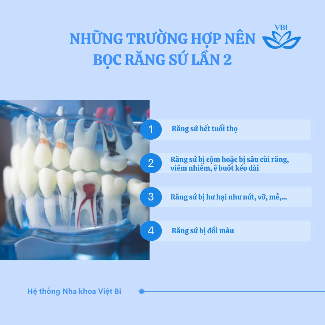 NHỮNG TRƯỜNG HỢP NÊN BỌC RĂNG SỨ LẦN 2