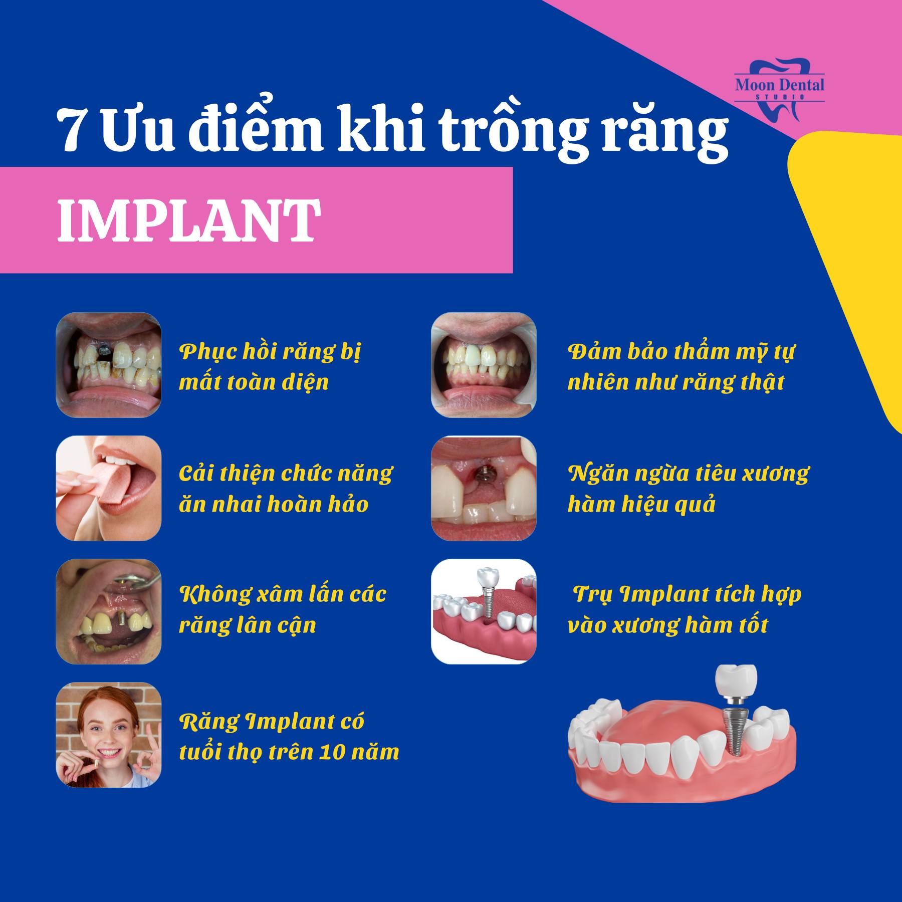 7 ƯU ĐIỂM KHI TRỒNG RĂNG IMPLANT